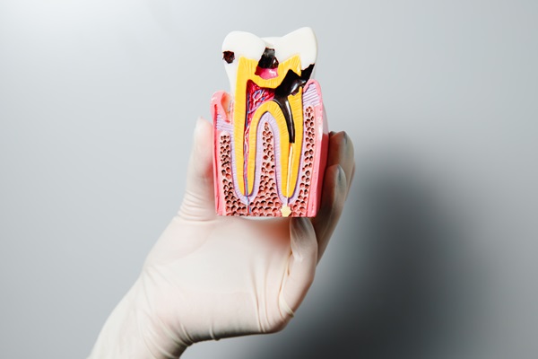 Debunking Root Canal Myths: How This Procedure Protects Oral Health